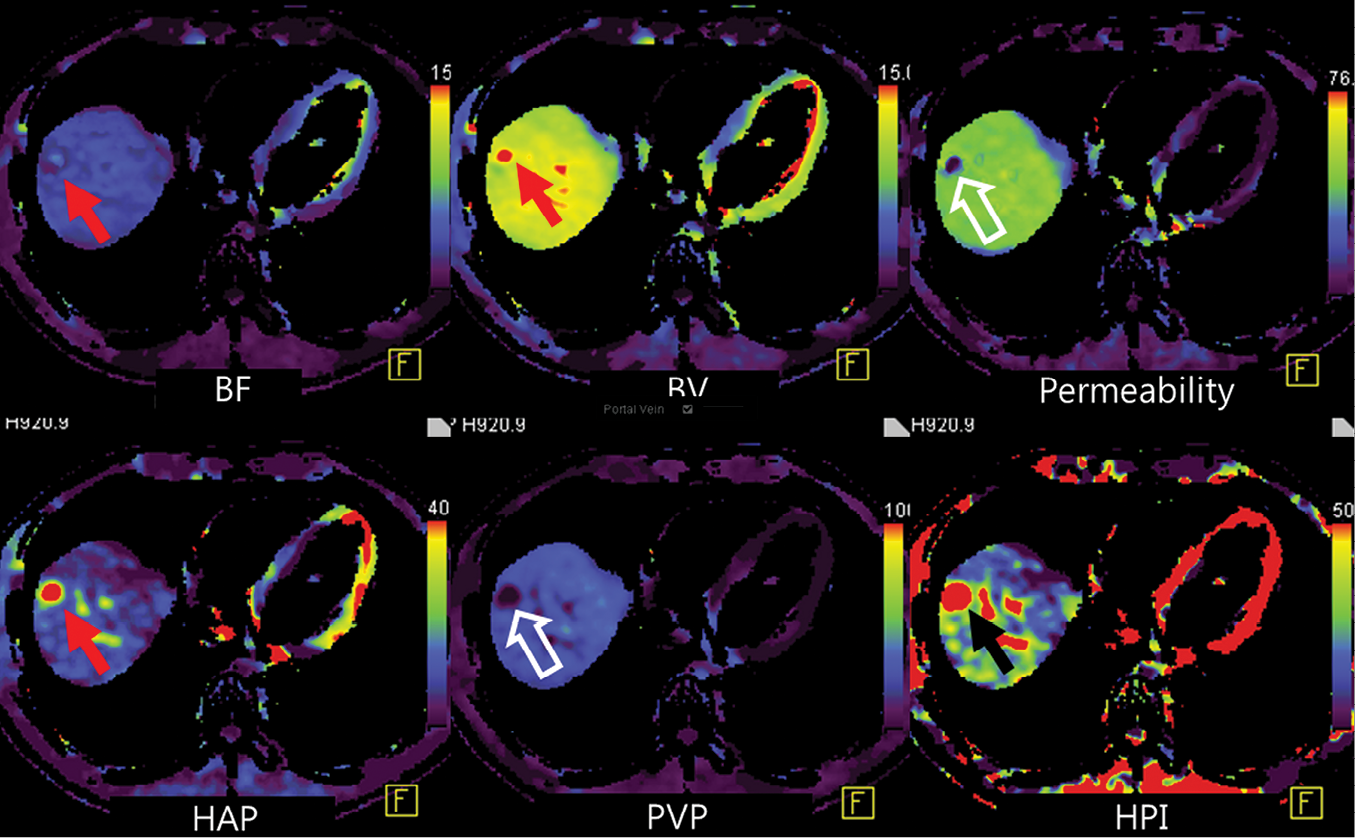Perfusion software used in this example automatically generates color-coded perfusion maps of entire liver
